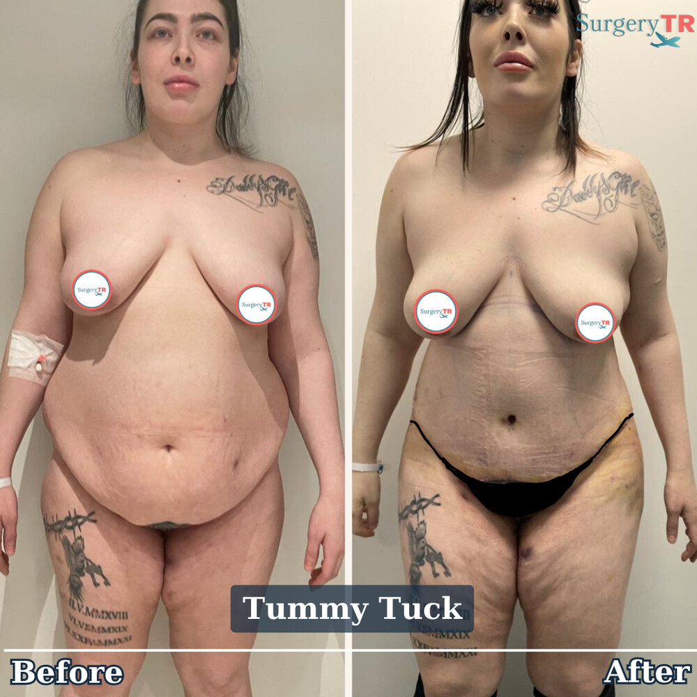 Before and After Result